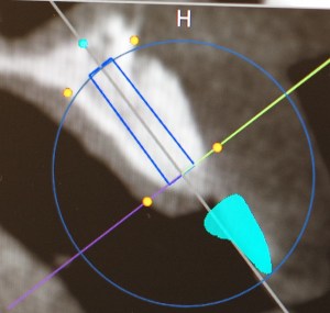 dental implant case study