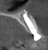 x-ray of a dental implant
