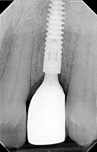 x-ray of a dental implant