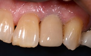 dental implant case study