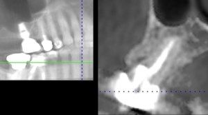 x-ray of a dental implant
