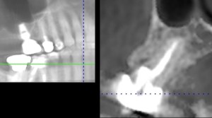 x-ray of a dental implant