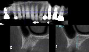 x-ray of a dental implant
