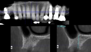 x-ray of a dental implant