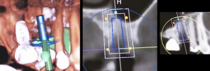 dental implant case study