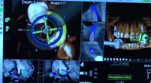 dental implant case study
