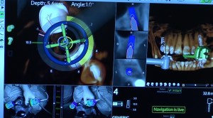 dental implant case study