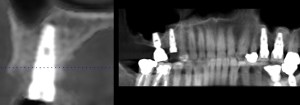 x-ray of a dental implant