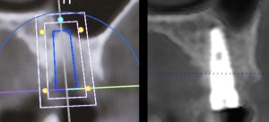 x-ray of a dental implant