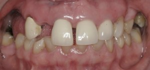 dental implant case study