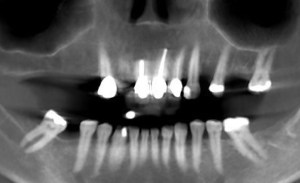 x-ray of a dental implant