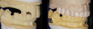 Molds of teeth