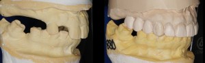 Molds of teeth