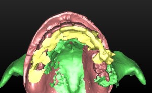 dental implant case study