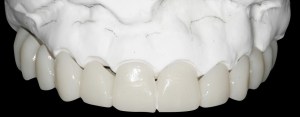 dental implant case study