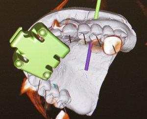 dental implant case study