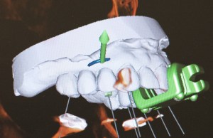 dental implant case study