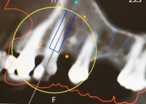 x-ray used for implant placement