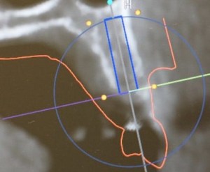 x-ray used for implant placement
