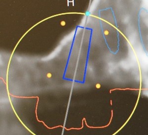 x-ray used for implant placement
