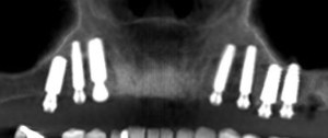 x-ray of dental implants