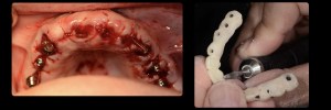 dental implant case study