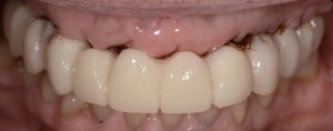 denture