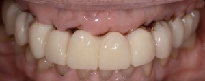 denture