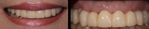 dental implant case study