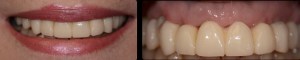 dental implant case study