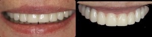 dental implant case study
