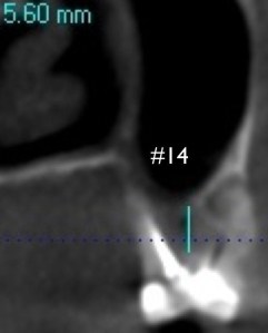 x-ray of a tooth