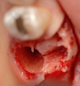 dental implant case study