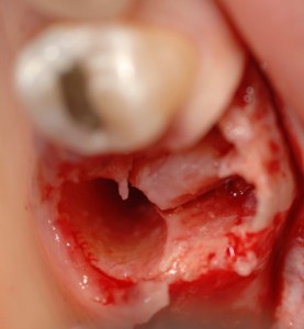 dental implant case study