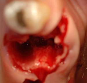 dental implant case study