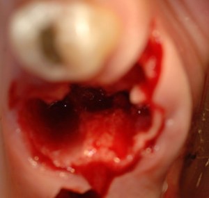dental implant case study