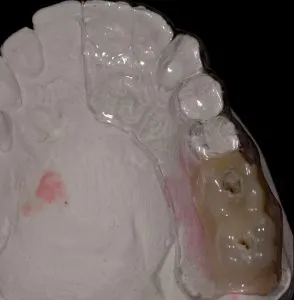 dental implant case study