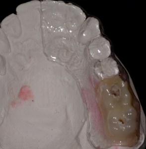 dental implant case study