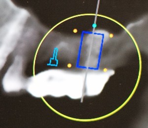 x-ray