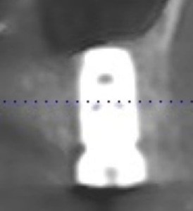 dental implant x-ray