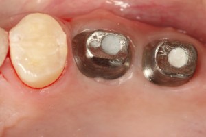 dental implant case study