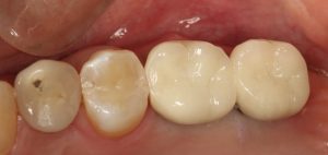 dental implant case study