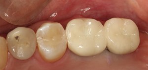 dental implant case study