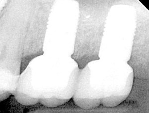 x-ray of two implants