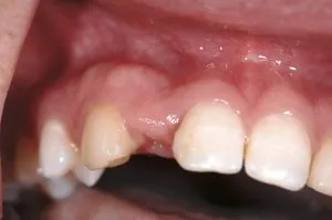dental implant case study