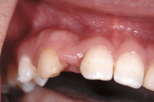 dental implant case study