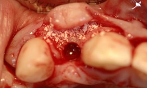 dental implant case study
