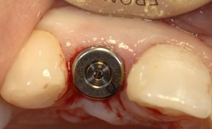 dental implant case study