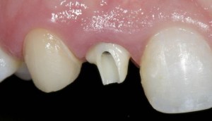 dental implant case study