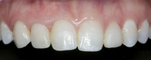 After dental implants